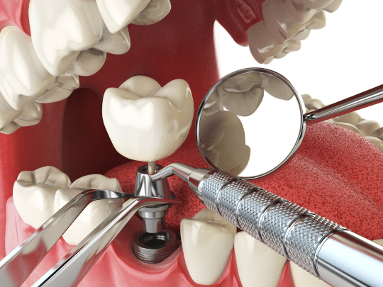 When Do You Need Dental Implant Surgery?