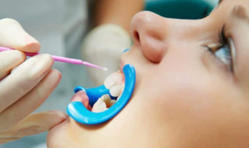 A Guide To Dental Sealants | Scruggs Family Dentistry