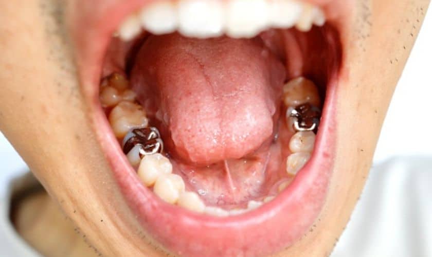 What Are Fillings? Types & Benefits Of Fillings.
