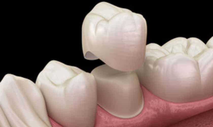 Dental-Crown-Placement