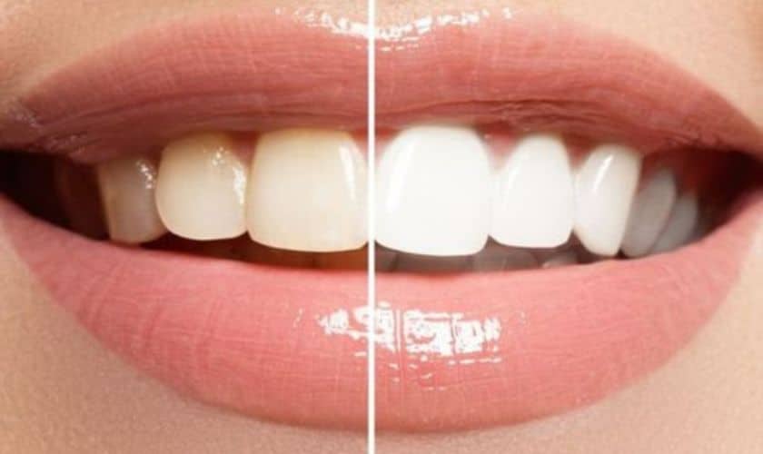 Teeth Whitening Shreveport