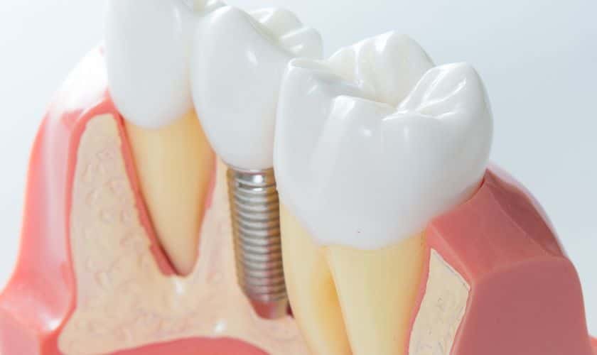 Dentures vs. Dental Implants: Making the Right Choice for You