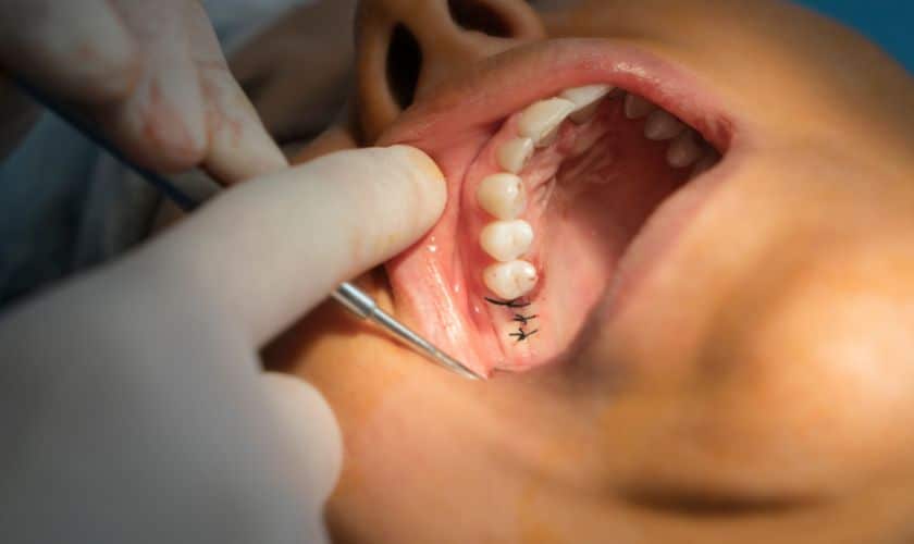 Dental Implants Shreveport