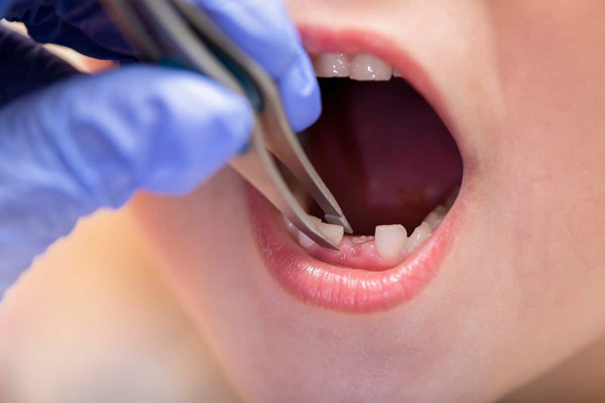 Tooth Extraction in Shreveport