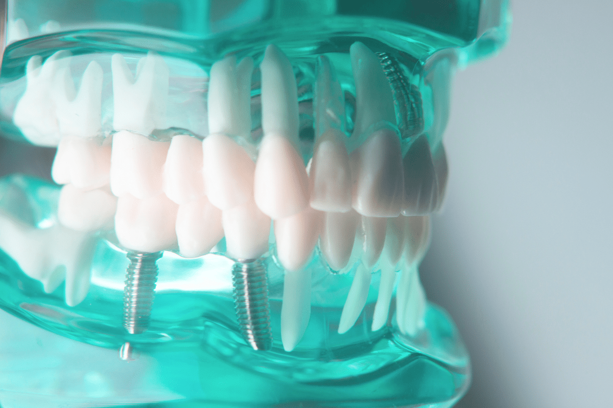 Understanding Osseointegration of Dental Implants