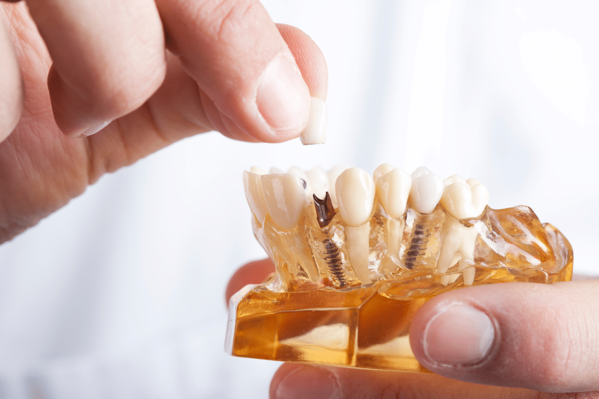 Complications After Dental Implants